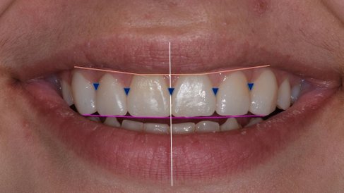 Travaux prothèse dentaire laboratoire p2h - exemple 1